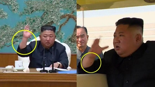 Tanda Bekas Operasi Kim Jong Un yang Masih Jadi Teka-teki