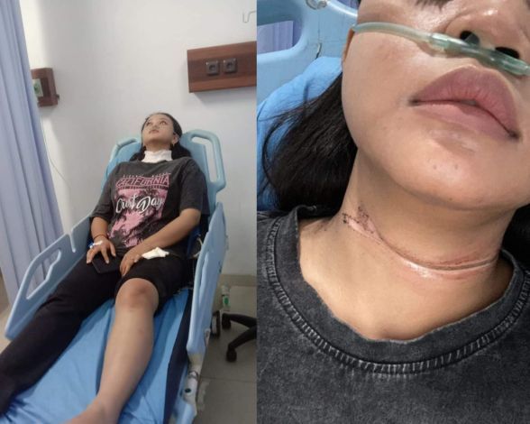 Terjerat Kabel Optik, Mahasiswi Pekanbaru Nyaris Tewas! Operasi Plastik Dilakukan
