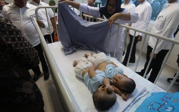 Bayi Kembar Siam Tapanuli Jalani Operasi Pemisahan 23 Juli
