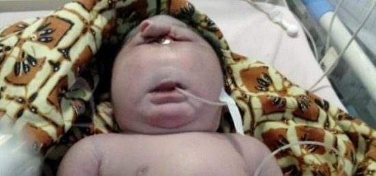 Bayi Lahir Mata Satu Tanpa Hidung di Siak Riau