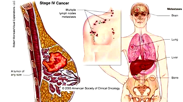 Wanita, Ini 7 Makanan Pencegah Kanker Payudara