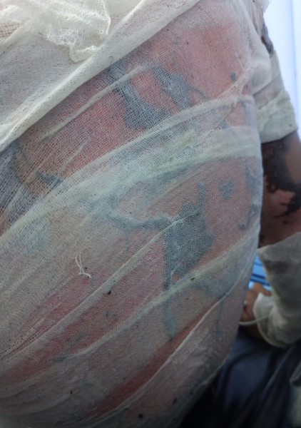 Pasang Kabel Internet, Separuh Tubuh Fathier Hangus Disetrum Listrik, DPRD Pekanbaru Desak My Republic Bertanggung Jawab