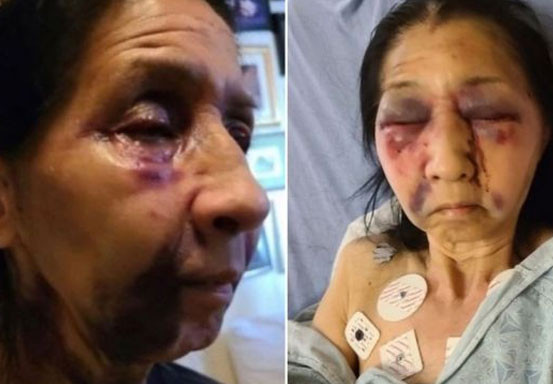 Seorang Nenek Dianiaya hingga Patah Hidung Disangka Keturunan Asia